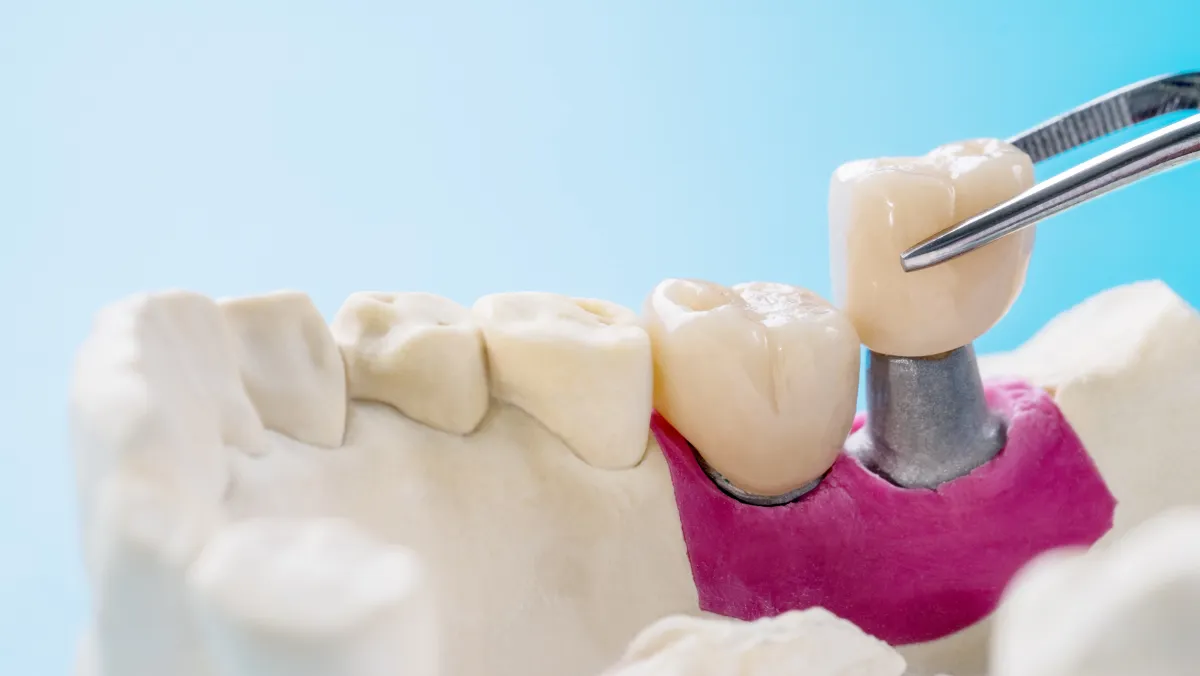 DMLS Crowns