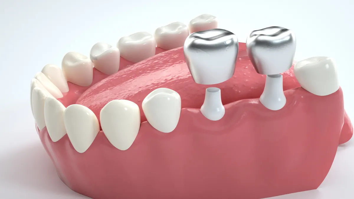 E max Crowns