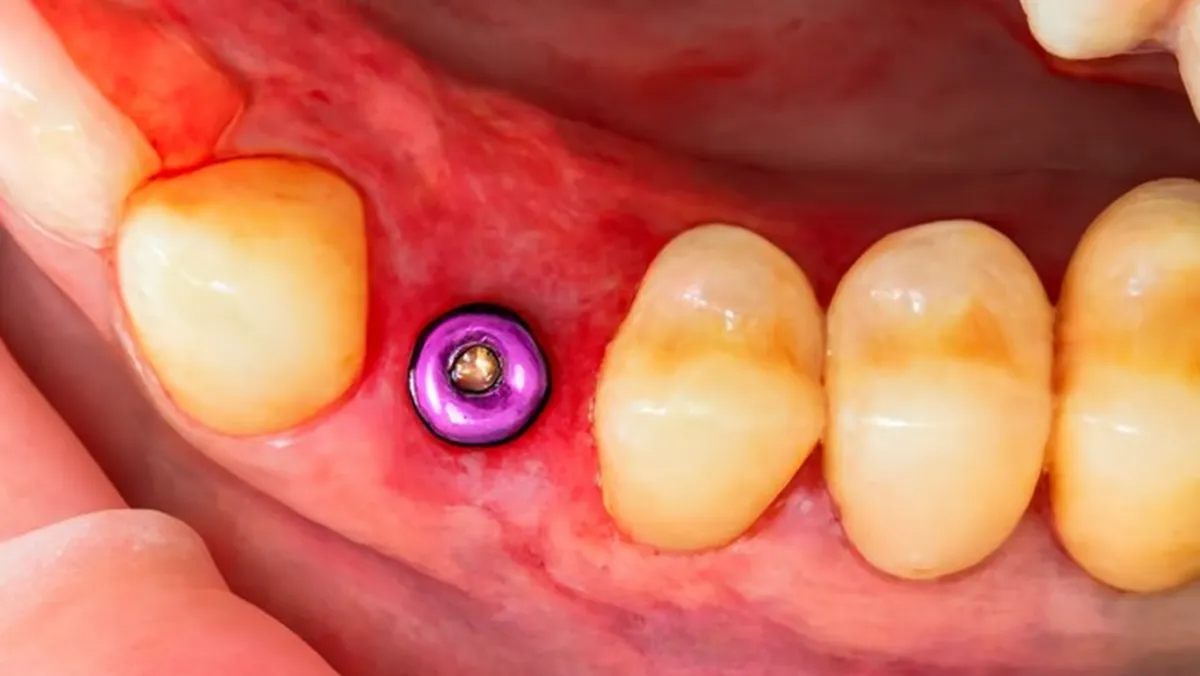 Failed Implant Management