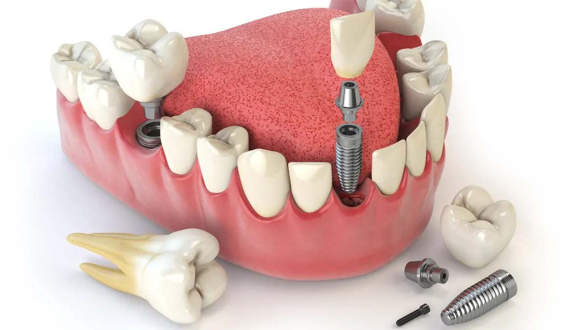 Short Implants