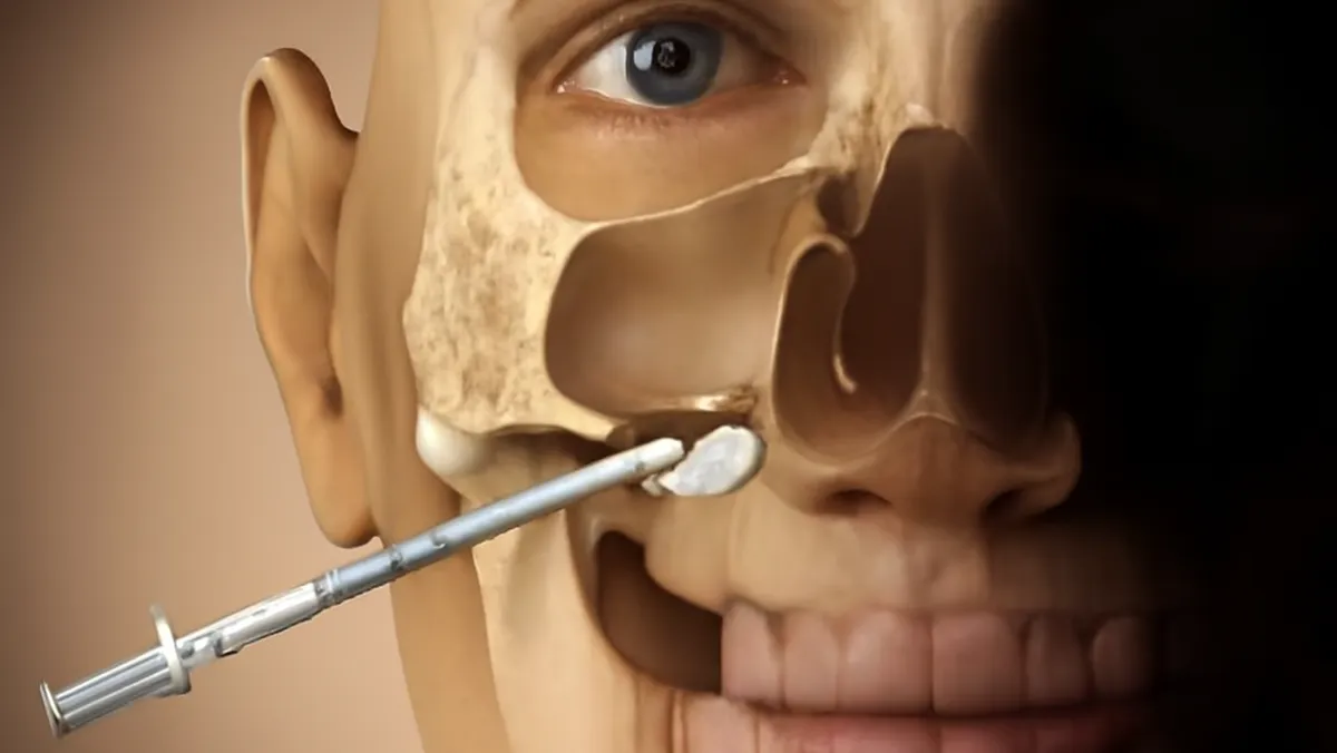 Sinus Lifting